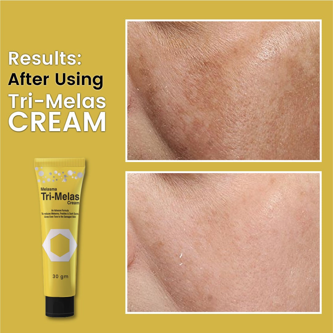 Dr Romia | Tri Melas Cream | The Best Pigmentation & Melasma Treatment